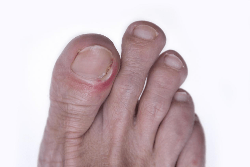 Der ultimative Leitfaden für Sandalen zur Pflege und Genesung eingewachsener Zehennägel - FitVilleDE
